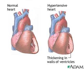 high blood pressure herbs, hypertension