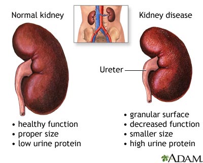 kidney cancer, kidney disease